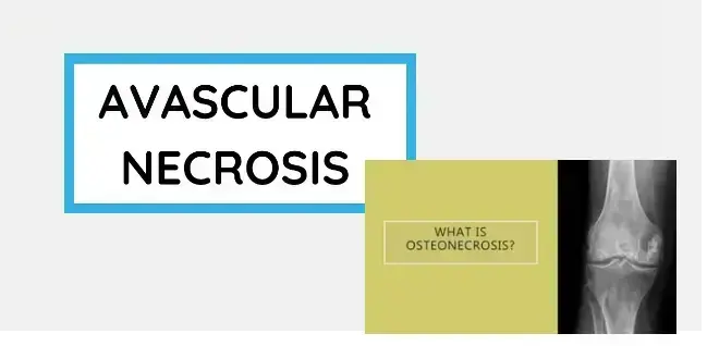 osteonecrosis:-understanding-symptoms-causes-and-treatment